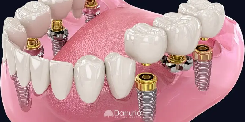 prótesis sobre implantes qué es una sobredentadura