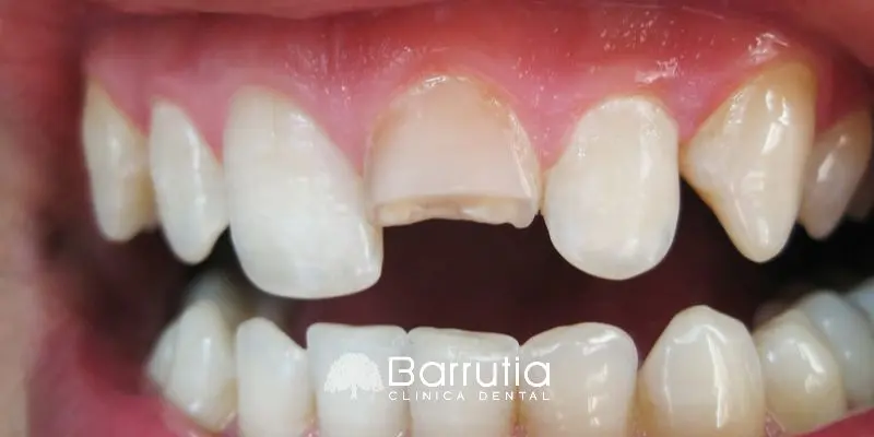 Traumatismo dental: qué hacer si se rompe o se cae un diente por un golpe