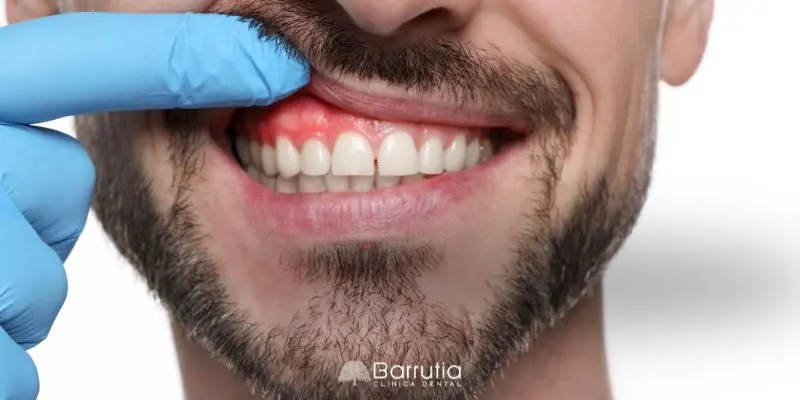 Cómo tratar la periodontitis