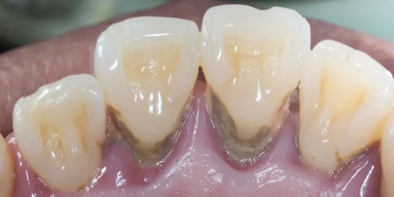 Periodontitis, actualización de las guías de práctica clínica