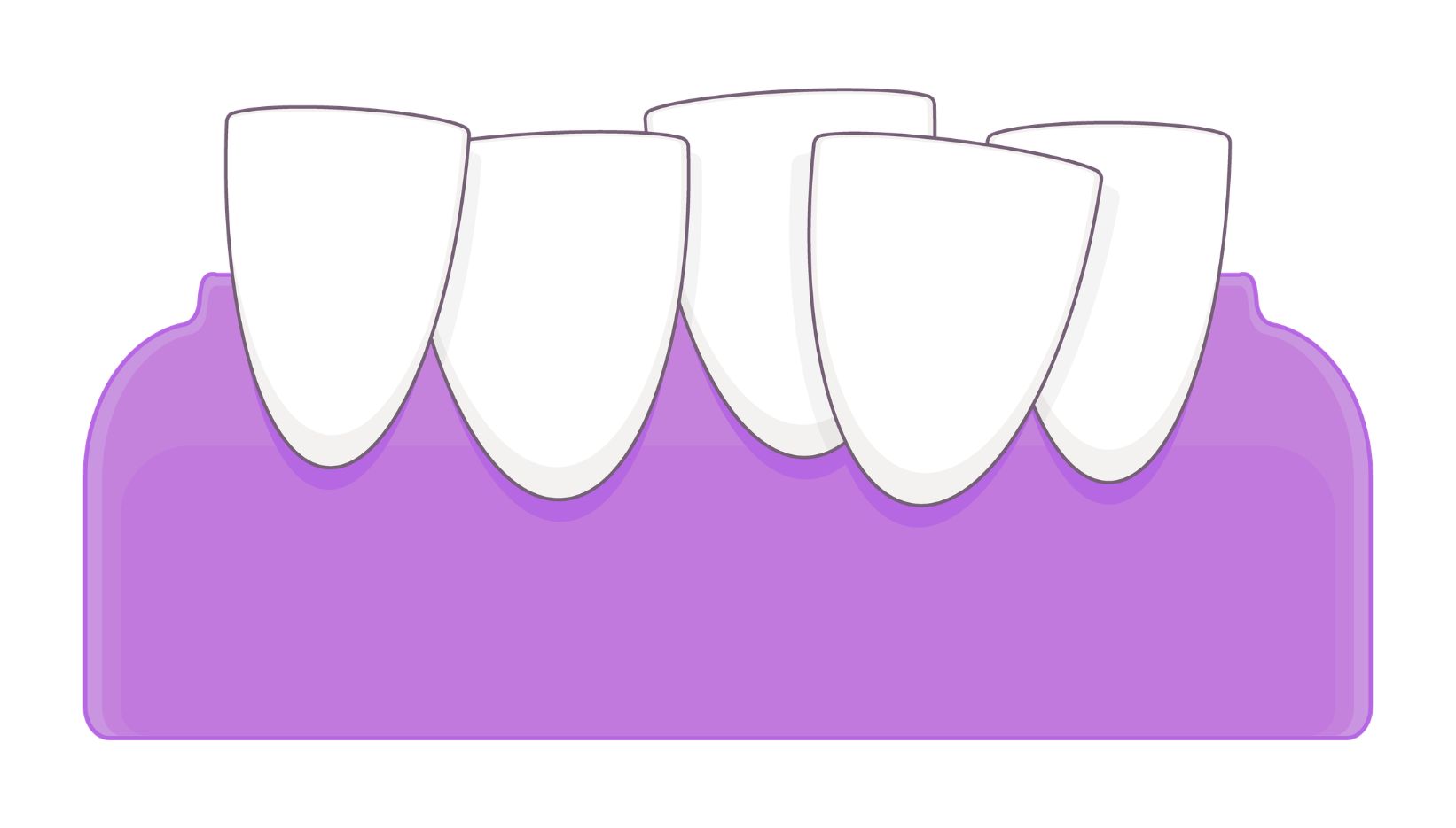 Dientes apiñados ortodoncia Getafe