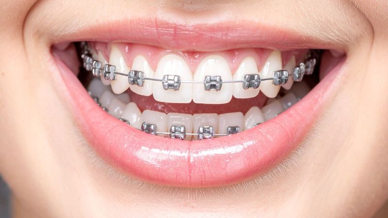 Brackets metálicos Getafe — Clínica Dental Barrutia