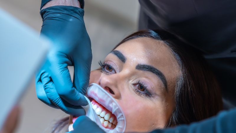 Blanqueamiento dental combinado clínica casa Getafe Clínica Dental Barrutia
